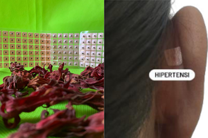 Terapi Auriculopuncture dan Herbal Bunga Rosella untuk Mengatasi Hipertensi