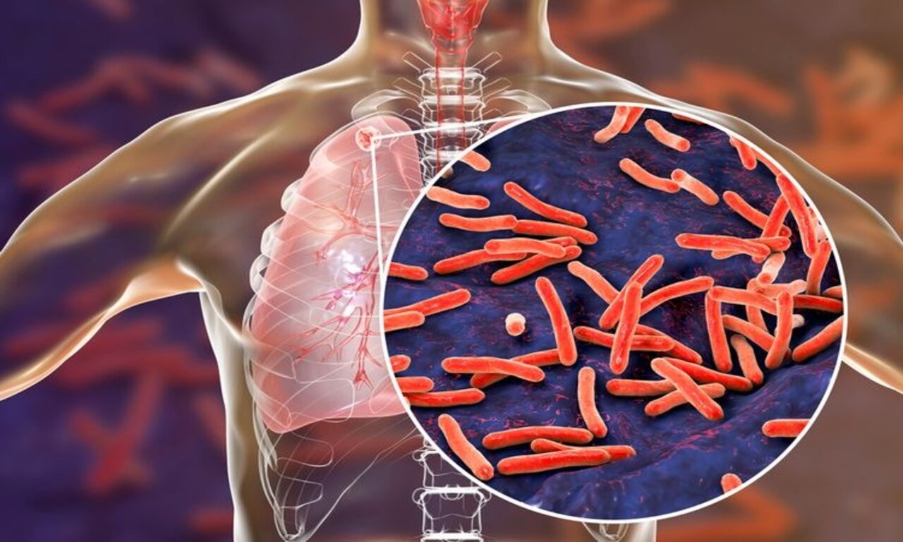 Ilustrasi bahaya penyakit tuberkulosis paru/gambar dari penulis