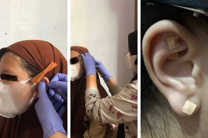 foto saat pemasangan ear seed pada responden (kiri dan tengah), letak titik aurikulo yang digunakan untuk penelitian (kiri) sebagai salah satu tahapan terapi aurikulopresur