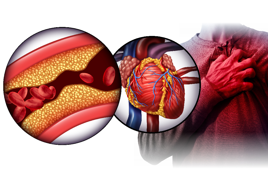 Mengenal Penyakit Jantung Koroner