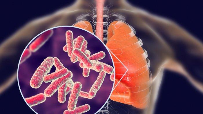 Angka Kejadian Tuberkulosis Paru di Rumah Sakit Universitas Airlangga Surabaya Tahun 2022