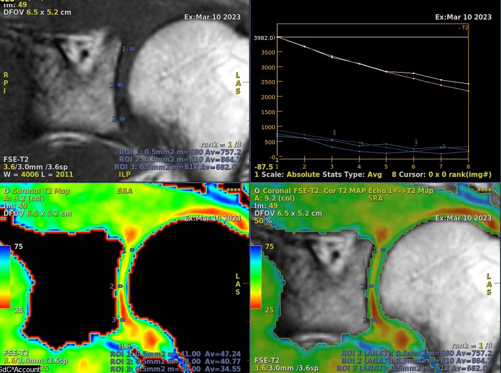 Deteksi Awal Osteoarthritis Sendi Bahu Menggunakan Terobosan Terbaru Pemeriksaan  MRI Dilengkapi dengan Color Map
