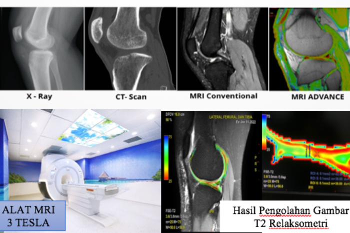 Peranan Pemeriksaan Radiologi MRI Lutut dengan Teknik Terbaik Untuk Mengevaluasi Osteoarthritis (OA)