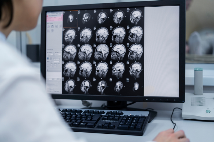 Ilustrasi Diagnosa Canggih Pada Citra MRI Brain untuk Klasifikasi Tumor/freepik