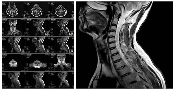 Penggunaan sequence FOCUS DWI pada Pemeriksaan MRI Cervical Untuk Mendiagnosa Kelainan Sumsum Tulang Belakang pada Cervical