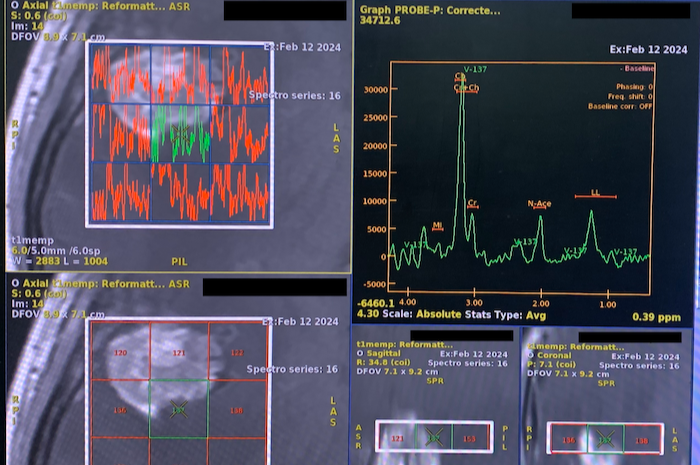 Tumor Otak Intra-Axial: Peran Multi Voxel Spectroscopy dalam Diagnosis/dokumen istimewa