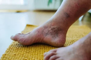 Balqies Salvialista Hanura_ Intervensi Buerger Allen Exercise Pada Pasien dengan Diabetic Foot - balqies salvialista