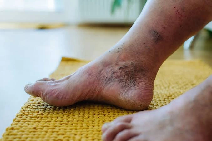 Balqies Salvialista Hanura_ Intervensi Buerger Allen Exercise Pada Pasien dengan Diabetic Foot - balqies salvialista