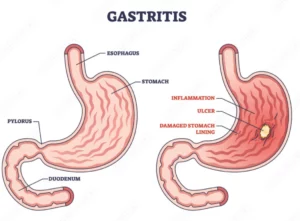 Peran Keluarga dalam Perawatan Pasien Gastritis_Shutterstock