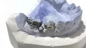 Pembuatan Space Regainer Banded Helical Retractor pada Kasus Tanggal Prematur Gigi 85_Dokumen Istimewa
