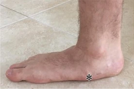 Apakah Bentuk Kaki Berhubungan dengan Keseimbangan Dinamis?_Dokumen Istimewa