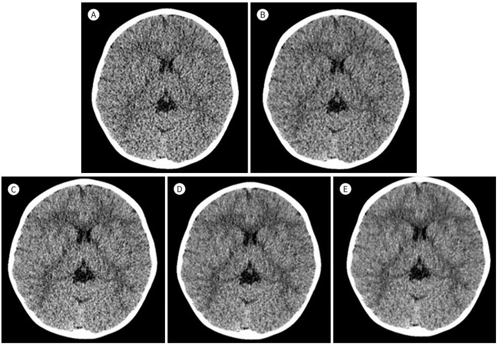 Deep Learning Reconstruction Tingkatkan Kualitas Citra CT Scan Kepala Non Kontras_Dokumen Istimewa