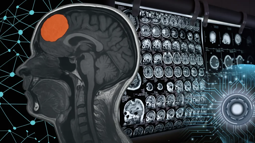 Hyperostosis Meningioma Identifier: Inovasi Deep Learning untuk Deteksi Otomatis Citra MRI Otak_Dokumen Isrimewa
