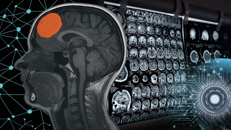 Hyperostosis Meningioma Identifier: Inovasi Deep Learning untuk Deteksi Otomatis Citra MRI Otak_Dokumen Isrimewa