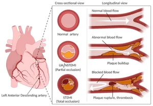 Kecemasan Berat Mengiringi Pasien Acute Coronary Syndrom (ACS)_MDPI