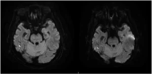 Akurasi Diagnosis Stroke dengan MRI Terbaru_Dokumen Istimewa