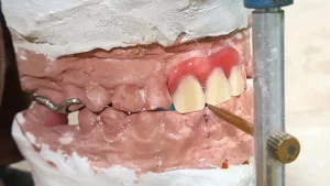 Pembuatan Gigi Tiruan Kerangka Logam pada Kasus Crossbite Anterior_Dokumen Istimewa