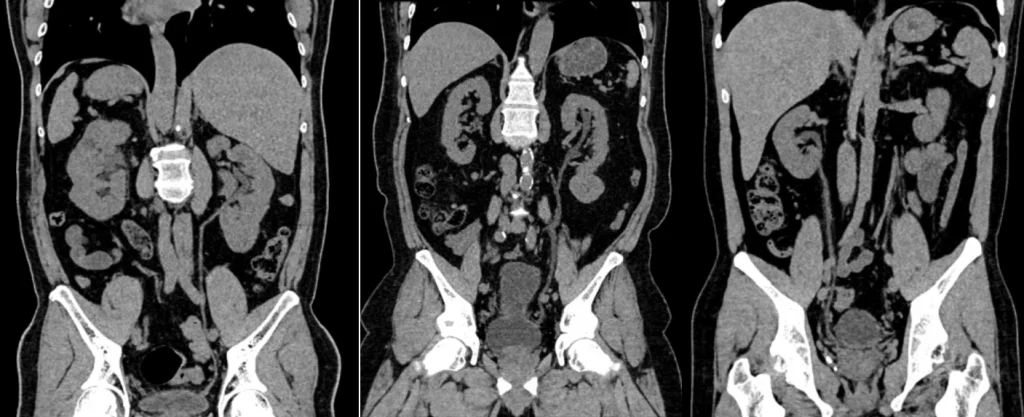 Teh Hitam vs Jus Semangka: Mana yang Lebih Baik untuk Pemeriksaan CT Scan Urografi Tanpa Kontras?_Dokumen Istimewa