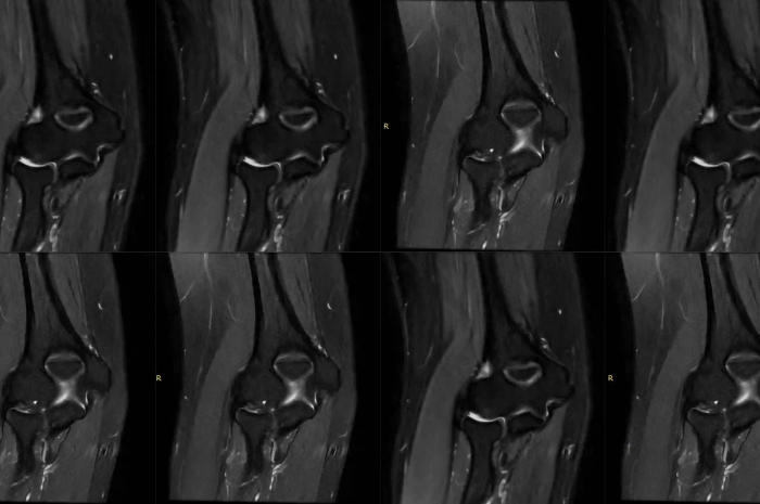 Fatsat VS Dixon Teknik Mana yang Lebih Unggul Untuk MRI Elbow?_Dokumen Istimewa