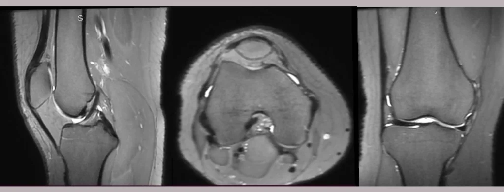 ARC MRI Genu 3D PD Fat Sat untuk Optimasi Citra_Dokumen Istimewa