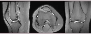 ARC MRI Genu 3D PD Fat Sat untuk Optimasi Citra_Dokumen Istimewa