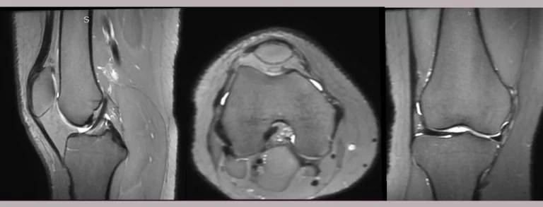 ARC MRI Genu 3D PD Fat Sat untuk Optimasi Citra_Dokumen Istimewa