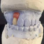 Rehabilitasi Estetika Gigi Anterior dengan Maryland PFM_Dokumen Istimewa