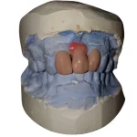 Rekonstruksi Estetika Anterior melalui Diagnostic Wax Up pada Kasus Space Kecil dan Resorpsi Gingiva_Dokumen Istimewa