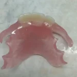 Gigi Tiruan Nylon Thermoplastic: Solusi Estetis untuk Kasus Resesi Gingiva_Dokumen Istimewa