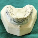 Prosedur Pembuatan Peranti Kombinasi Long Span Adams Clasp pada Kasus Maloklusi_Dokumen Istimewa