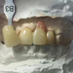 Restorasi Zirkonia Monolitik Polikromatik Tingkatkan Estetika pada Kasus Edge-to-Edge dan Alveolar Ridge Defect_Dokumen Istimewa