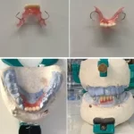 Solusi Gigi Hilang dengan Antagonis Berdesakan: Teknik Pembuatan GTSL Akrilik_Dokumen Istimewa