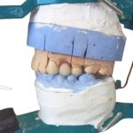 Pembuatan Fixed Bridge Metal Ceramic Pada Gigi 23, 24, dan 25 Dengan Kasus Resorpsi Tulang Alveolar Pada Pontik