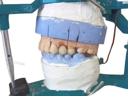 Pembuatan Fixed Bridge Metal Ceramic Pada Gigi 23, 24, dan 25 Dengan Kasus Resorpsi Tulang Alveolar Pada Pontik