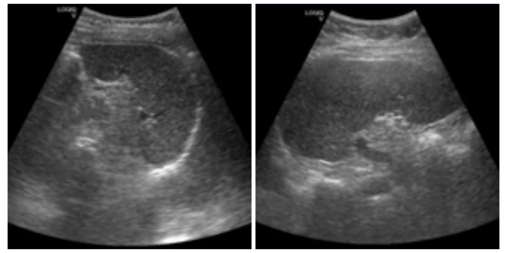 Analisis Pengaruh Variasi Frekuensi Transduser Convex Terhadap Kualitas Citra Ultrasonografi Lien Kasus Obesitas_Dokumen Istimewa
