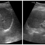 Analisis Pengaruh Variasi Frekuensi Transduser Convex Terhadap Kualitas Citra Ultrasonografi Lien Kasus Obesitas_Dokumen Istimewa