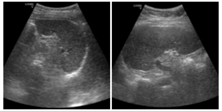 Analisis Pengaruh Variasi Frekuensi Transduser Convex Terhadap Kualitas Citra Ultrasonografi Lien Kasus Obesitas_Dokumen Istimewa