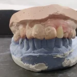 Prosedur Pembuatan Gigi Tiruan Sebagian Lepasan Nilon Termoplastik yang Estetik Dengan Kasus Gigi Berdesakan Anterior_dokumen istimewa