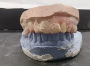 Prosedur Pembuatan Gigi Tiruan Sebagian Lepasan Nilon Termoplastik yang Estetik Dengan Kasus Gigi Berdesakan Anterior_dokumen istimewa