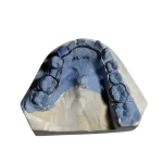 Pencegahan Terjadinya Gigi Berjejal (Crowding) Pada Anak Menggunakan Peranti Lingual Arch Space Maintainer_Dokumen Istimewa