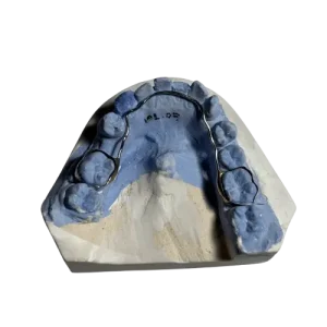 Pencegahan Terjadinya Gigi Berjejal (Crowding) Pada Anak Menggunakan Peranti Lingual Arch Space Maintainer_Dokumen Istimewa