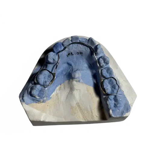 Pencegahan Terjadinya Gigi Berjejal (Crowding) Pada Anak Menggunakan Peranti Lingual Arch Space Maintainer_Dokumen Istimewa