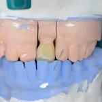 Teknik Pembuatan Full Crown Estetik Berbahan Lithium Disilicate Gigi 21 Dengan Kasus Anterior Crossbite_Dokumen Istimewa