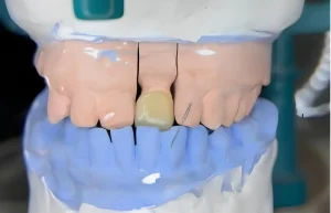 Teknik Pembuatan Full Crown Estetik Berbahan Lithium Disilicate Gigi 21 Dengan Kasus Anterior Crossbite_Dokumen Istimewa