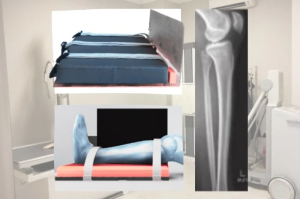 Inovasi Alat Fiksasi Radiografi Cruris Menjawab Tantangan Positioning