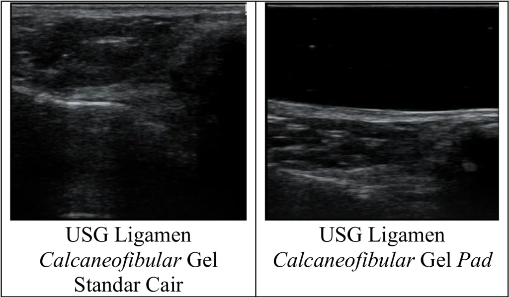 Analisis Perbandingan Penggunaan Gel Standar dan Gel Pad Terhadap Kualitas Citra Pada USG Ligamen Calcaneofibular
