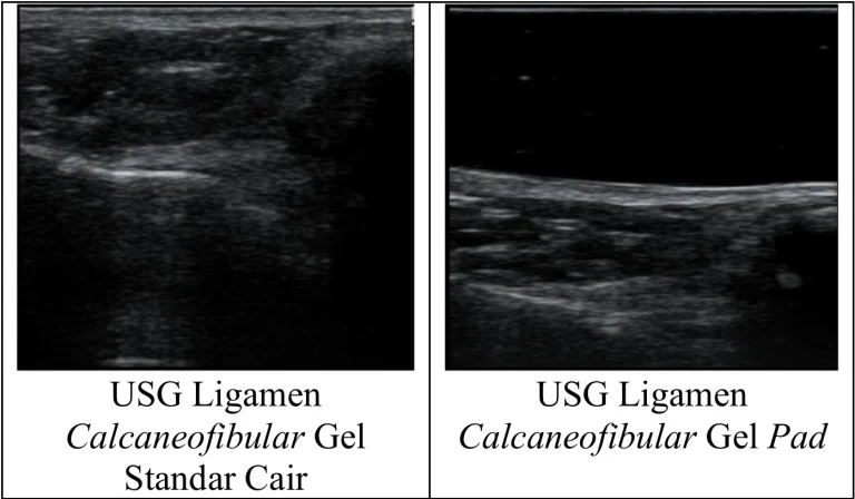 Analisis Perbandingan Penggunaan Gel Standar dan Gel Pad Terhadap Kualitas Citra Pada USG Ligamen Calcaneofibular
