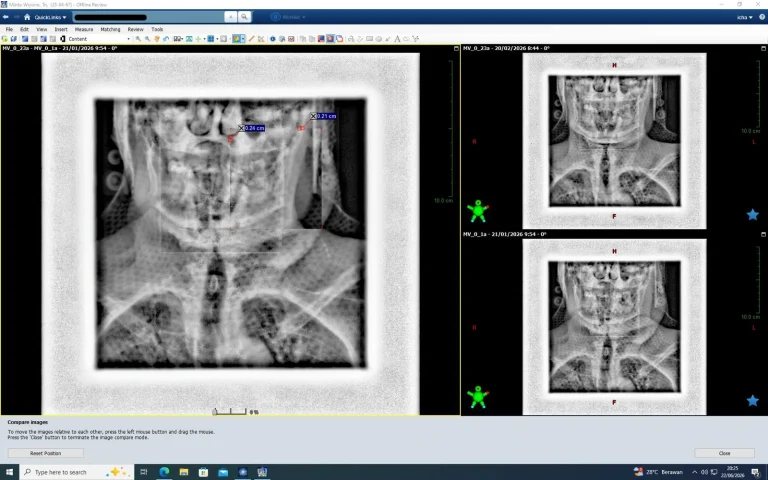 Berat Badan Turun, Akurasi Radioterapi Kanker Nasofaring Ikut Berubah