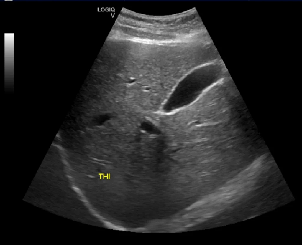 Perbandingan citra USG B-Mode konvensional dan Tissue Harmonic Imaging pada pemeriksaan kantung empedu
