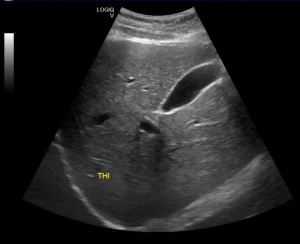 Perbandingan citra USG B-Mode konvensional dan Tissue Harmonic Imaging pada pemeriksaan kantung empedu